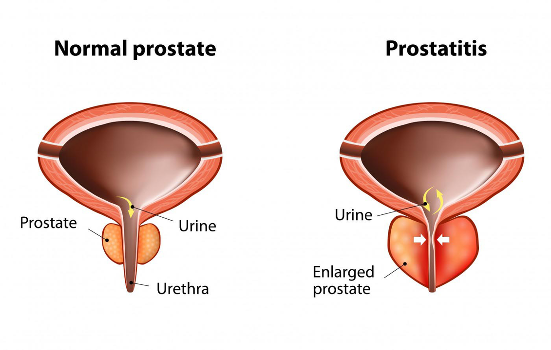 Normalna prostata zdravog čovjeka i upala prostate s prostatitisom