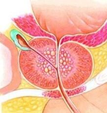 Adenom prostate