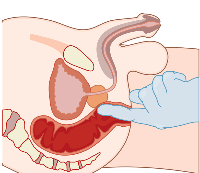 Masaža prostate s prostatitisom